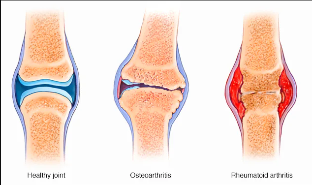 Understanding Leg Pain and Arthritis Symptoms