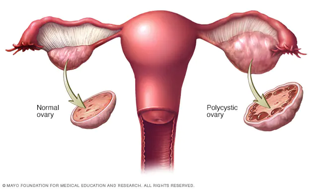 Understanding PCOS and Its Treatment