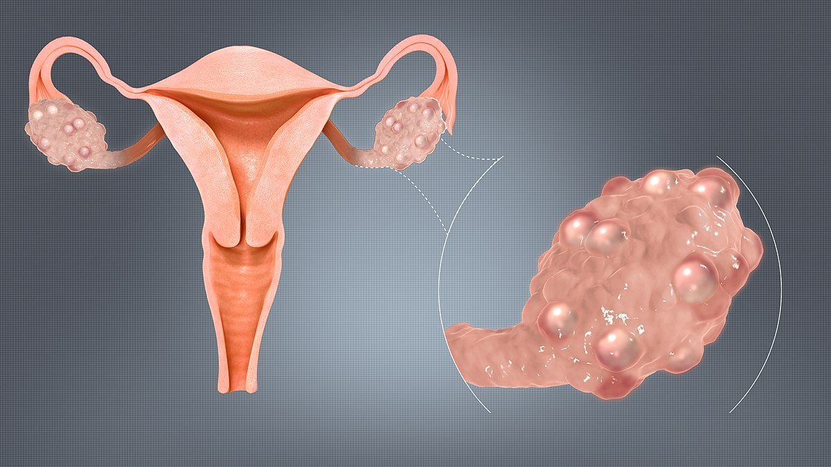 Understanding PCOS: Causes, Symptoms, and Treatment – Sanior Hospitals
