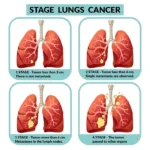 Lung Cancer