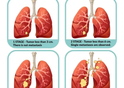 Lung Cancer