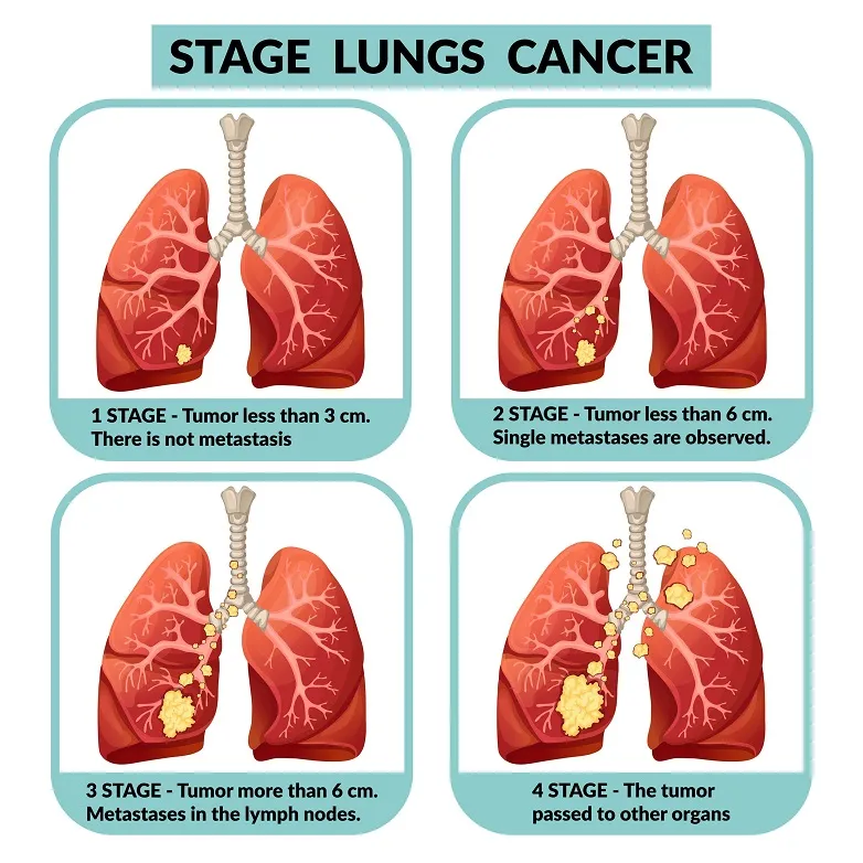 Lung Cancer : Symptoms & Treatment