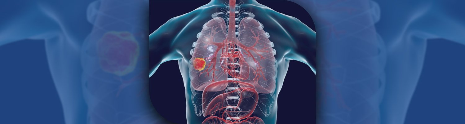 Lung Cancer