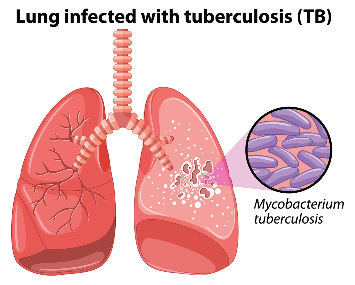 TUBERCULOSIS- where  do we stand today?